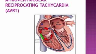 Supraventricular tachycardia [upl. by Latt]