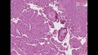 Histopathology Thyroid Papillary carcinoma [upl. by Eupheemia467]