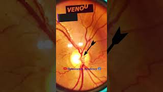 Venous Pulsation  Normal fundus  Normal Retina  Fundus Photography  Short Video 101 optometry [upl. by Simah854]