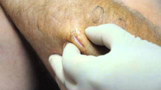 How to remove lipoma in 30 seconds [upl. by Brannon275]