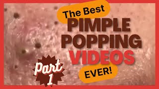 The BEST pimple POPPING videos EVER p1 [upl. by Siegler860]