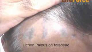 Lichen Planus on scalp treated using homeopathy by Dr Rajesh Shah MD [upl. by Immak]