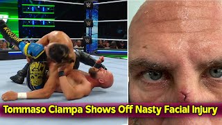 Tommaso Ciampa Shows Off Nasty Facial Injury After WWE Speed Title Match [upl. by Enilada]