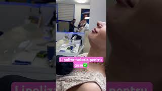 lipoliza liposuction beauty estetica [upl. by Tierney]