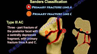 Calcaneal IntraArticular Fractures Sanders  Everything You Need To Know  Dr Nabil Ebraheim [upl. by Sirrep]