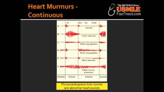 Heart Murmurs  Patent Ductus Arteriosus PDA [upl. by Aldercy65]