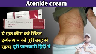 Atonide cream 005 use dose benefits and side effects full review in hindidesonide cream [upl. by Todhunter]