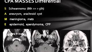 Cerebellopontine Angle Lesions [upl. by Reeva365]