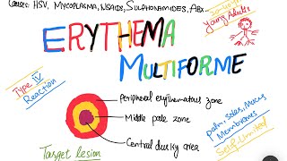 Erythema Multiforme EM causes symptoms treatment  skin disorder [upl. by Thier]