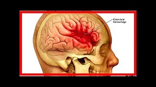 Ischemia cerebrale sintomi diagnosi e cura [upl. by Duster]