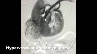 Renal Angiomyolipoma AML Transcatheter Ethanol Alcohol Embolization [upl. by Grindlay]