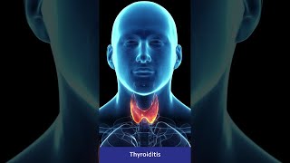 Types of Thyroiditis amp Its Symptoms  Practo Shorts [upl. by Anidan]