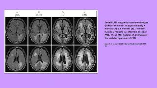 Neurology Quiz 95 Progressive multifocal leukoencephalopathy PML [upl. by Notanhoj]