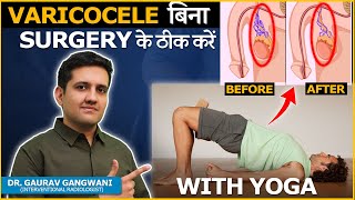 Yoga for Varicocele Relieve Pain and Promote Circulation  Dr Gaurav Gangwani [upl. by Hameerak]