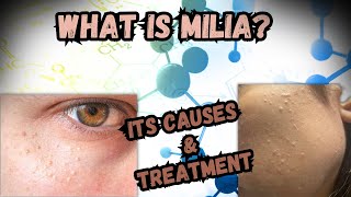 What Is Milia What Are Its Causes And Its Treatment [upl. by Edyak795]