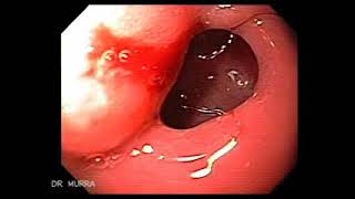 histoplasmosis gastroduodenal [upl. by Slinkman883]