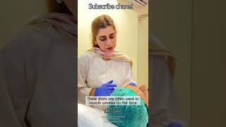 Botox Before After Treatment Results botoxinjector botoxtreatment fillers skincare yt pakistan [upl. by Auberbach102]