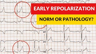 Early repolarization syndrome and pattern Norm or pathology [upl. by Ennirok]