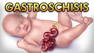 Gastroschisis Pathophysiology Diagnosis Treatment and Comparison against Omphalocele [upl. by Elahcim]