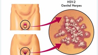 العلاج القمعي لمرض الهربيسالتناسلي [upl. by Atiuqihc834]