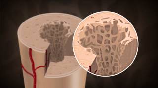 What causes Osteoporosis [upl. by Laamak182]