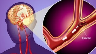 Stroke Prevention amp Transient Ischemic Attack TIA [upl. by Khosrow297]