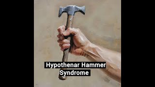 Hypothenar Hammer Syndrome [upl. by Winni]