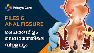 Piles Anal Fissure Treatment in Malayalam  Pristyn Care  For Free appointment call 9821388242 [upl. by Winson]