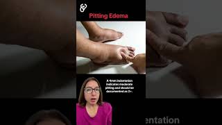 Pitting Edema Health Assessment SHORT  LevelUpRN [upl. by Bab]