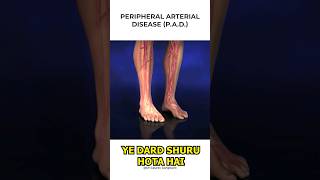 Claudication In Legs Symptoms  Claudication  Leg Pain  Dr Gaurav Gangwani [upl. by Australia]