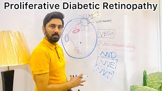 Proliferative Diabetic Retinopathy [upl. by Davison]