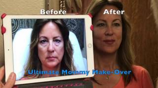 LIQUID FACELIFT  ULTIMATE Dermal Filler MAKEOVER [upl. by Grimaud215]