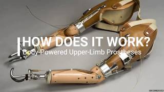 How Does a Body Powered Upper Limb Prostheses Work [upl. by Kolodgie]