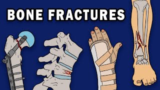 BONE FRACTURES [upl. by Netnert459]