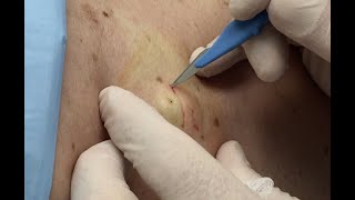 Gambit Part 1 AbscessCyst Treatment Dr Gilmores Birthday [upl. by Garihc]