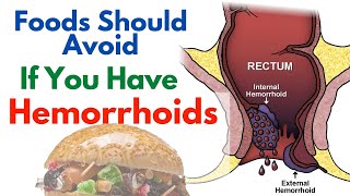 9 Foods That Make Hemorrhoids Worse  Foods To Avoid For Hemorrhoids [upl. by Campbell]