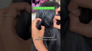 Shocking results of Antidandruff Oil  Before after  Vilvah  For The Real You [upl. by Bouton]