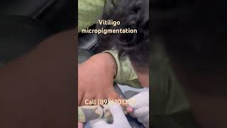 Vitiligo micropigmentation treatment  vitiligo pigmentation safeddaag ilaj [upl. by Millicent]