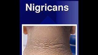 Acanthosis Nigricans [upl. by Ardy832]