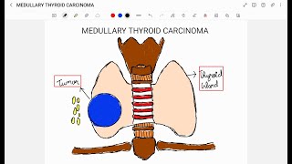 MEDULLARY THYROID CARCINOMA [upl. by Nyrroc]