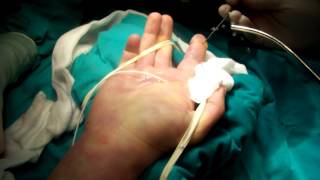 Flexor Tendon Sheath WashoutMOV [upl. by Esela567]