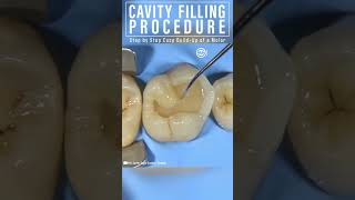 Dental Cavity Filling Procedure shorts medical tech dental teeth training [upl. by Nosac952]