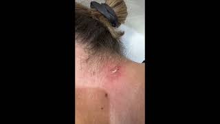 OMG Cyst Explosion  Watch This Massive Pop 💥 PimplePopper pimplepopping cystpoping [upl. by Morrell]