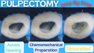 Pulpectomy ⚪️ Step By Step Demonstration 🔵 Baby Blue Pediatric Rotary Endodontic Files [upl. by Anitteb538]