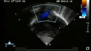 Type I Persistent Truncus Arteriosus [upl. by Pantin57]