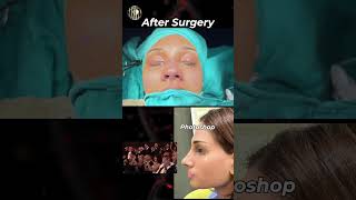 ultrasonicrhinoplasty rhinoplasty lahore pakistan nosejob nosereshaping dns [upl. by Ynehteb]