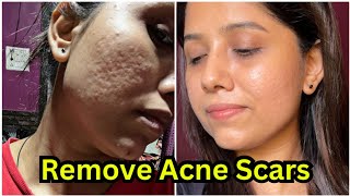 How to remove acne scars 😍  Acne scars remove treatment  My skin transformation journey [upl. by Lleda947]