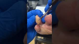 Witness the transformation Aussie Podiatrist vs Pinch Callus FootCare TylomaRemoval [upl. by Boesch]