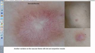 Dermoscopy Made Simple  Dermatofibroma [upl. by Henrietta]