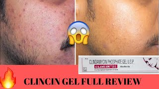 CLINCIN GEL FULL REVIEW IN DETAILक्या कील मुहासे होंगे गायब😃😰🤨🤨 [upl. by Brechtel]